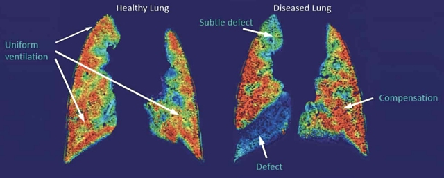 4DMedical ASX IPO 4DX lung imaging XV technology